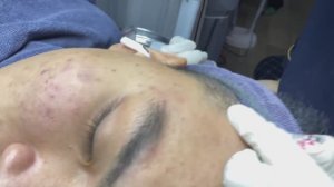 Asmr. Лечим угревой сыпи. #ТТ713