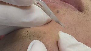 Глубокая чистка лица для мужчины ТТ#9