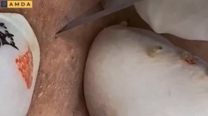 Глубокая чистка кожи лица от прыщей и черных точек #2151