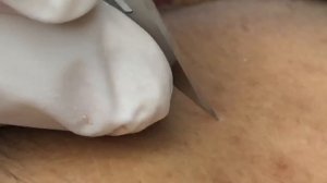 Извлечение глубоких стержней акне у парня ТТ#15