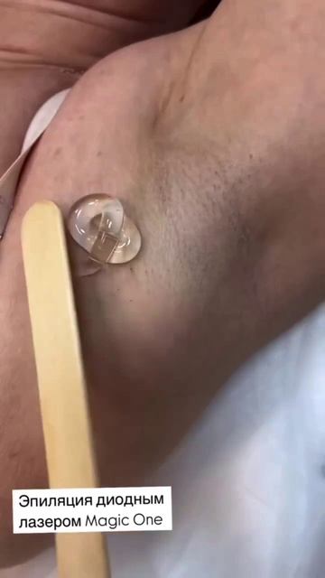 Эпиляция лазером  Magic One