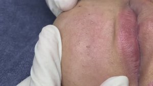 Профессиональная чистка от прыщей: Впечатляющие результаты. #ТТ712