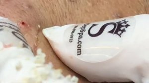 Полная чистка: удаление скрытых прыщей и белых угрей ТТ#5