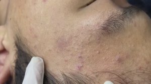 Asmr. Очищение кожи от угрей. #ТТ716