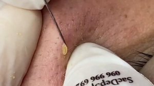 Выдавливание прыщей, угрей, черных точек и камедонов #232