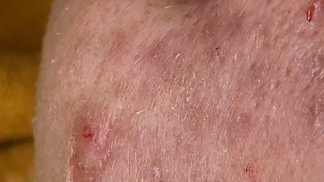 Asmr. Профессиональное очищение от угрей. #TT717