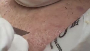 Удаление подкожных закрытых комедонов для парня ТТ#6