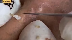 Глубокая чистка кожи лица от прыщей и черных точек #2169