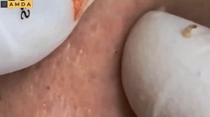 Глубокая чистка кожи лица от прыщей и черных точек #2153