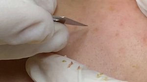 Комплексная чистка: воспаленные акне и закрытые комедоны ТТ#26