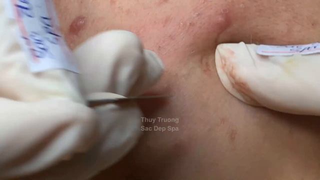 Закрытые комедоны: не лечишь → получаешь шрамы ТТ#2