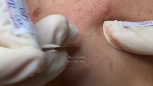 Закрытые комедоны: не лечишь → получаешь шрамы ТТ#2