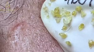 Убирание милиумов иглой: делать только у специалиста! LN34tt