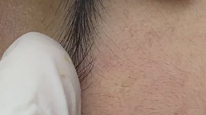 Мелкие незаметные прыщики у девушки #ТТ44