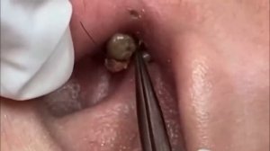 Чистка лица от угрей и акне. Выдавливание прыщей. Удаление черных точек и комедонов