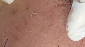 Упрямые закрытые комедоны / Часть 2 / Новая процедура #ТТ46