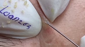 Asmr. Очищение лица от угрей. LN8yy