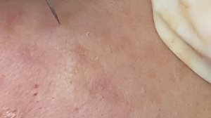 Глубокие подкожные прыщи на ногах у девушек #ТТ51