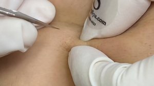 Чистим закрытые комедоны / Полная экстракция ТТ#31