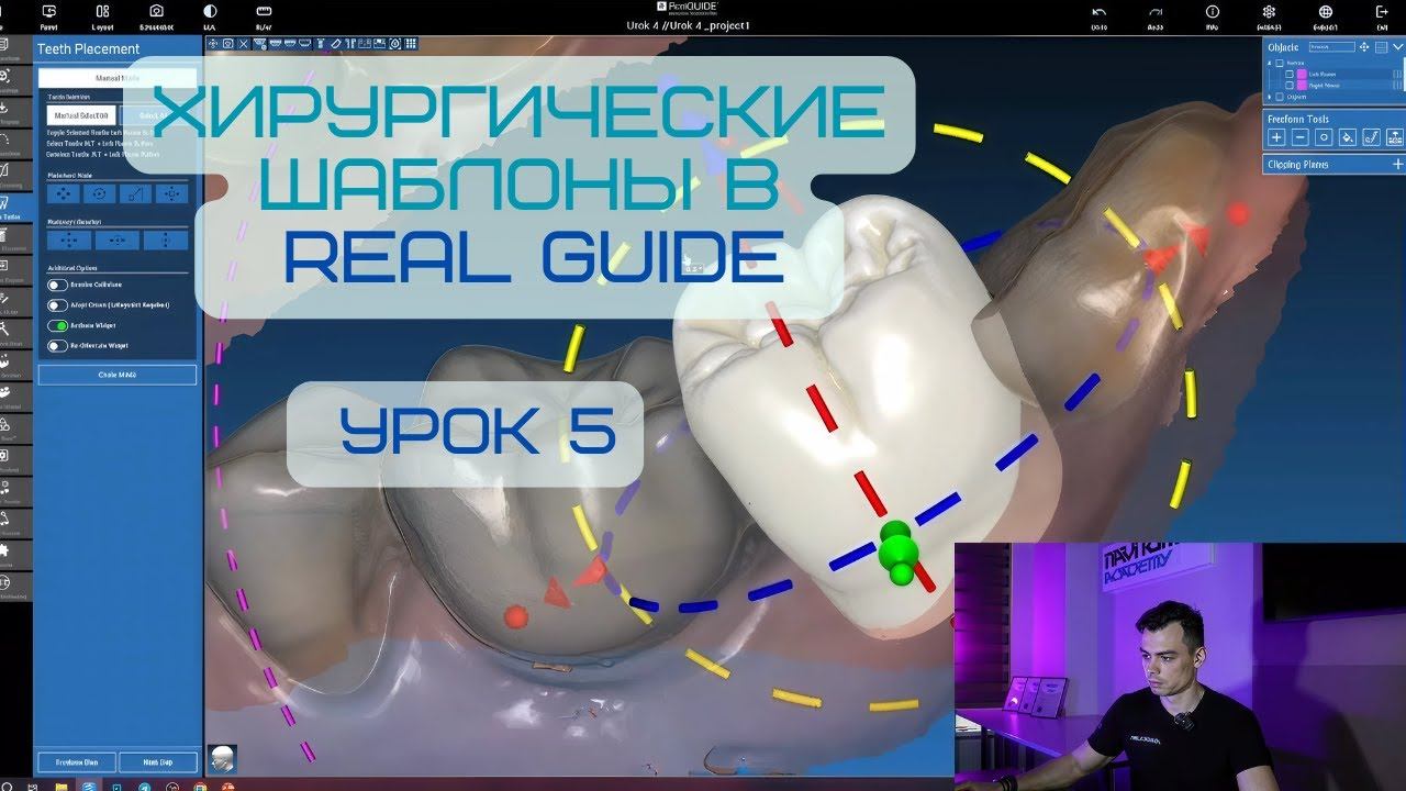 Обновленный курс в программе Real Guide. Урок 5. Сопоставление КТ и скана, настройка Waxup