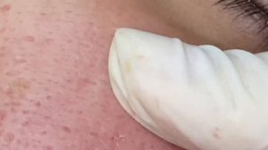 Скрытые комедоны и себумные филаменты у парня ТТ#30