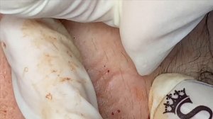 Подкожные прыщи, слабая чувствительная кожа и ярко выраженная сосудистая сетка #ТТ41