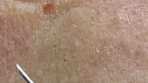 Asmr. Профессиональное избавление от белых точек. LN11y