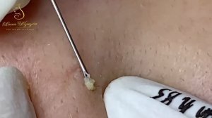 Механическая чистка от милиумов: удаление LN2yy