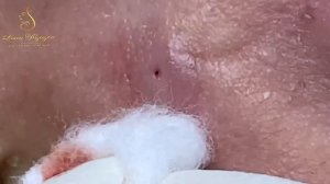 Техника механического очищения (удаления) милиумов LN10yy