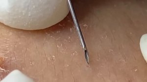 Выдавливание прыщей, угрей, черных точек и камедонов #234