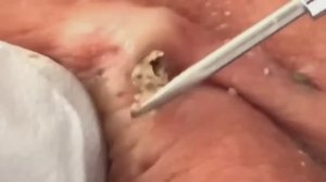 Чистка лица от угрей и акне. Выдавливание прыщей. Удаление черных точек и комедонов