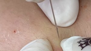 Лечение угревой сыпи. Акне #ТТ57