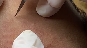 Закрытые комедоны у парня #ТТ49