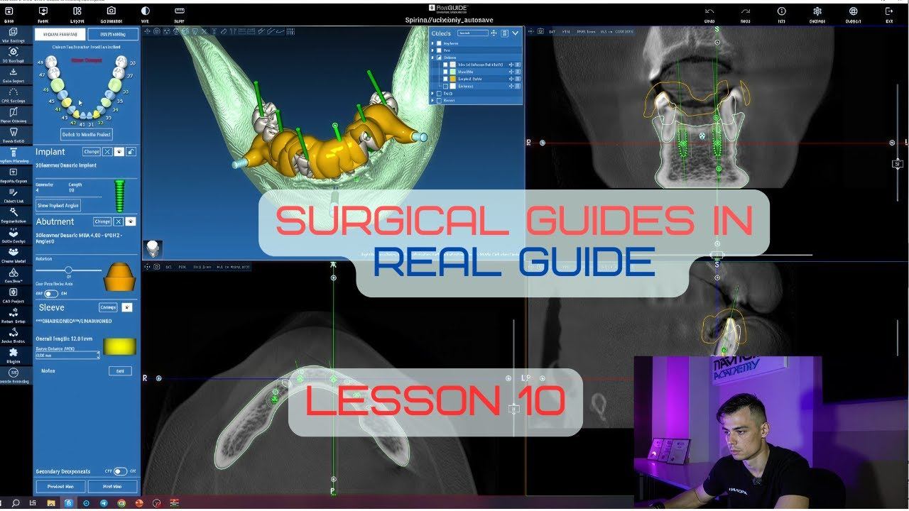 Surgical Guides In RealGuide Tutorial. Lesson 10. All On 6 Guide With One-stage Teeth Extraction