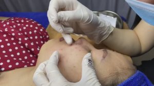 Глубокие черные точки (комедоны) у девушки ТТ#29