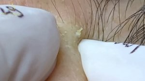 Выдавливание милиумов и черных точек у косметолога LN37_1tt