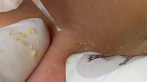 Черные точки (угри) под кожей — устранение #ТТ55