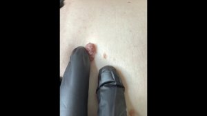 Удаление новообразований на коже тела