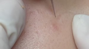 Лечение акне: скрытые прыщи и гематомы у девушки #ТТ48