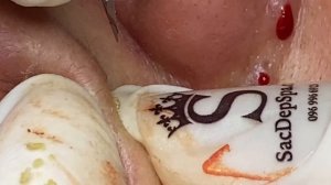 Серьезное воспаление на носу: прыщи и отек ТТ#47