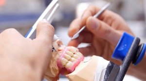 Балочный протез на имплантах