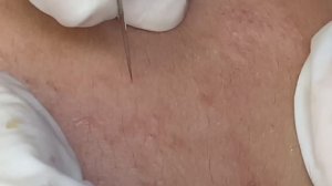 Деликатное удаление черных точек #ТТ53