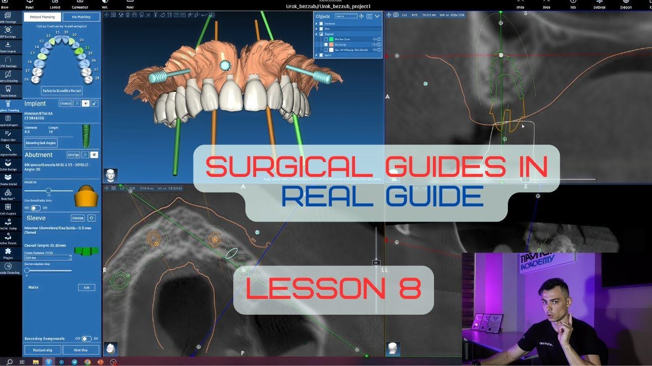 Surgical Guides In RealGuide Tutorial. Lesson 8. Edentulous Jaw Based Guide, All In 4 Guide