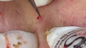 Выдавливание прыщей, угрей, черных точек и камедонов #235