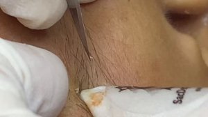 Парень с проблемными черными точками / Реальная процедура #ТТ42