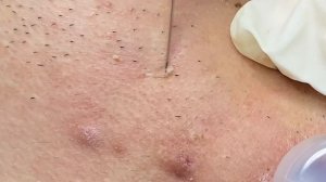 Лечение акне у пожилых людей / Возрастные прыщи #ТТ50