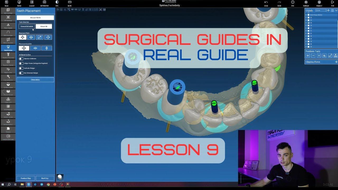 Surgical guides in RealGuide Tutorial. Lesson 9. All on 6 guidee with one-stage tooth extraction смотреть онлайн