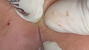 Стойкие скрытые прыщи, которые портят жизнь #ТТ45