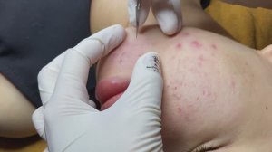 Экстракция (удаление) угрей и прыщей - ТТ#77