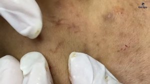 Видео: как профессионал чистит лицо от милиумов.